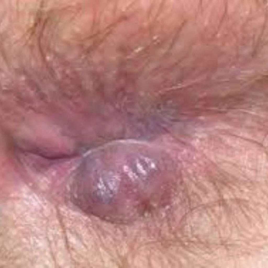 Piles (Hemorrhoids)