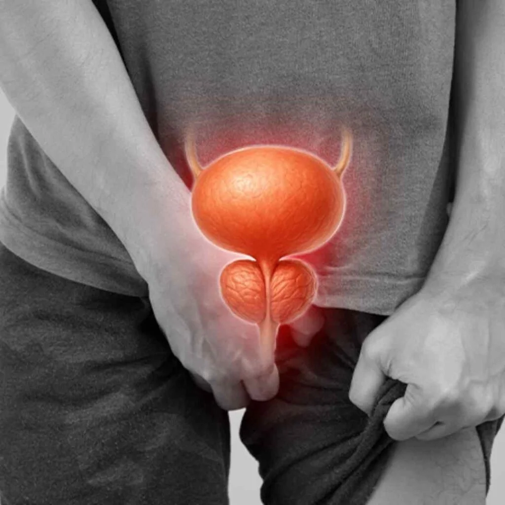 Prostate Enlargement (BPH)