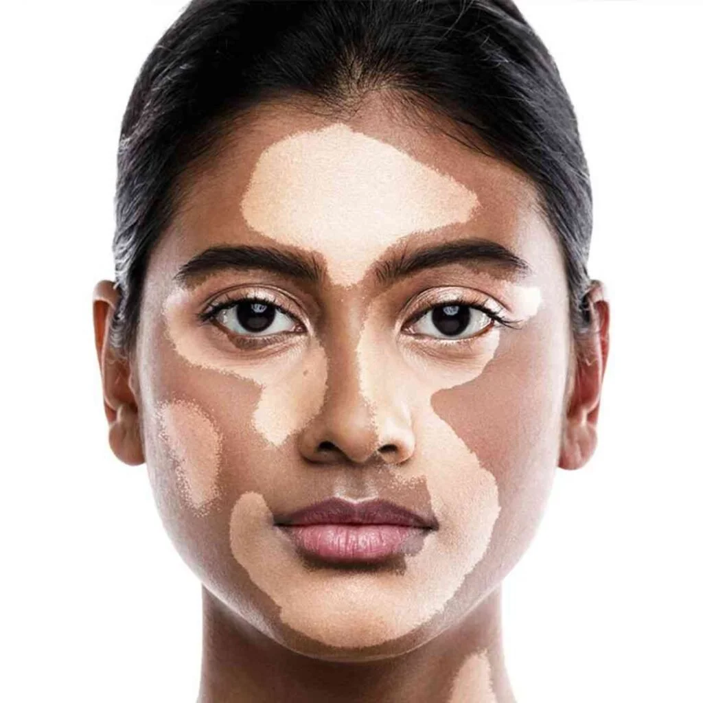 Vitiligo (White Spots)