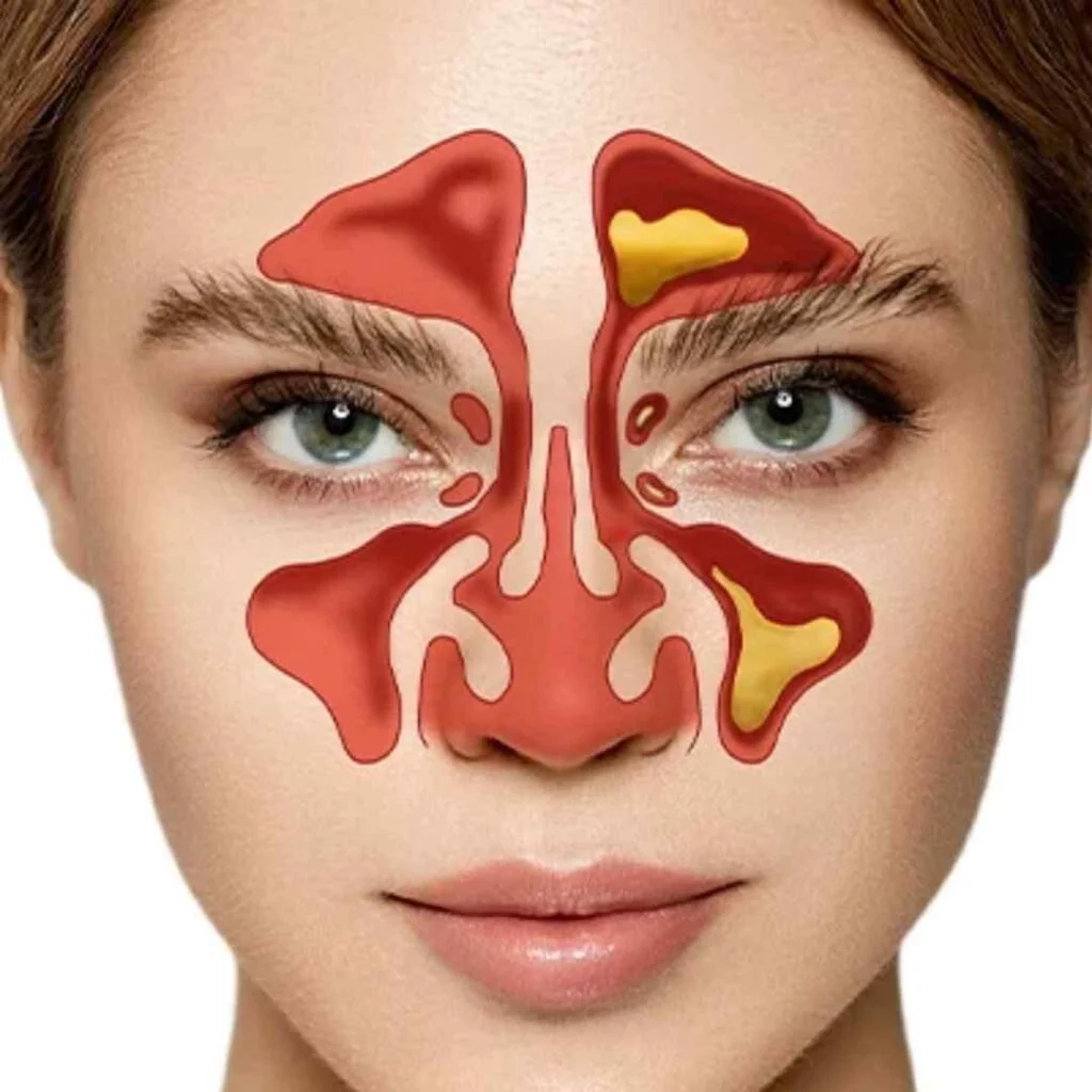 Sinusitis & Sinus