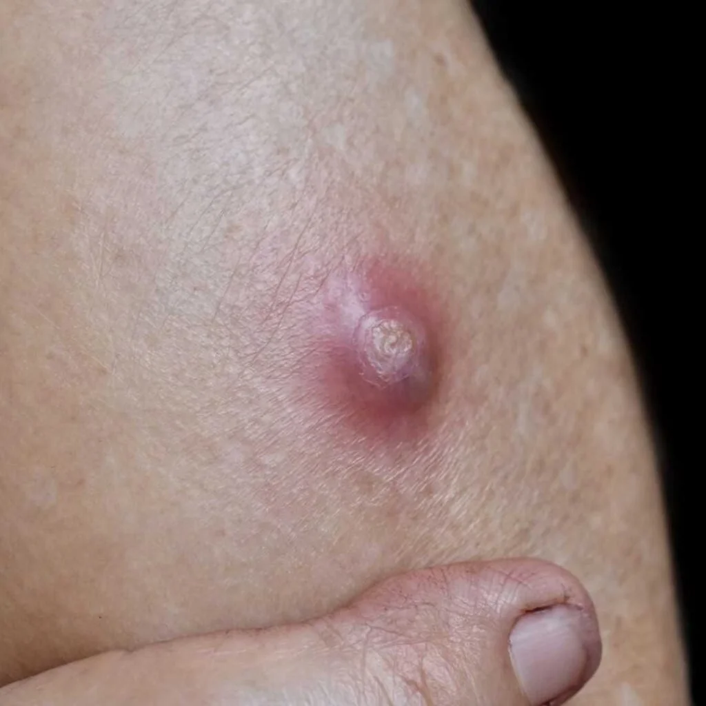 Cysts & Lipoma