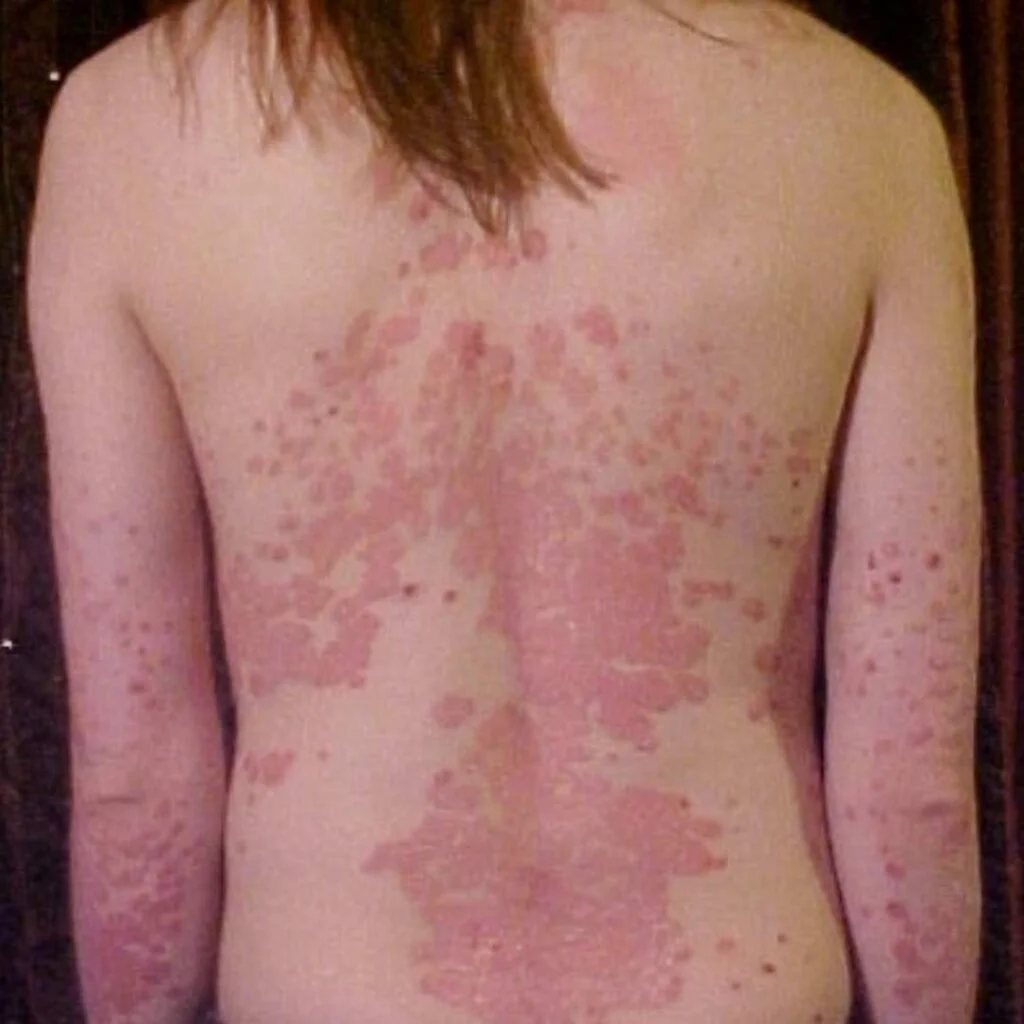 Psoriasis Care