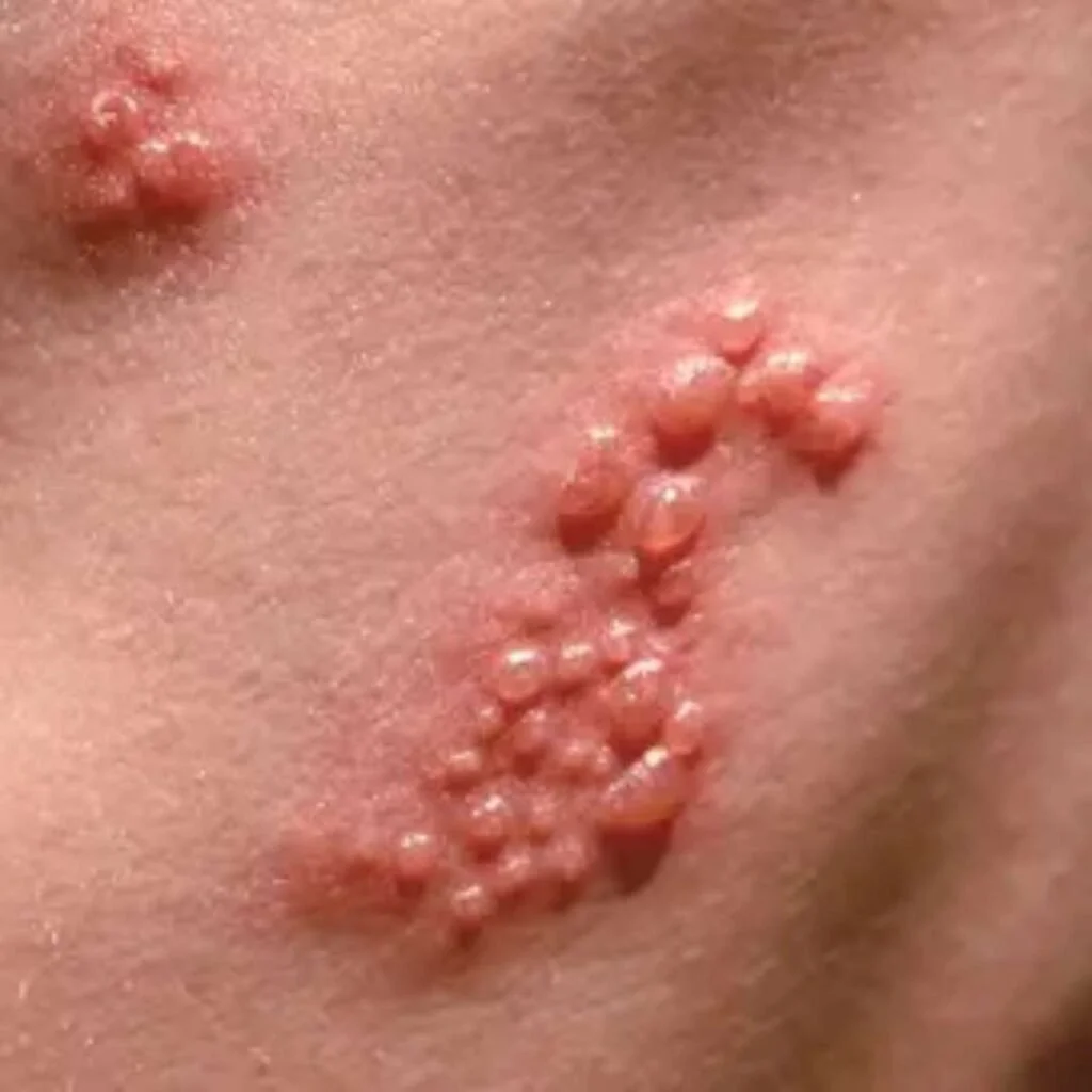 Herpes Infection